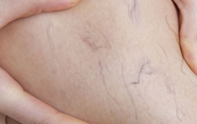 4 vitamini, ki preženejo krčne žile 4 vitamini, ki preženejo krčne žile